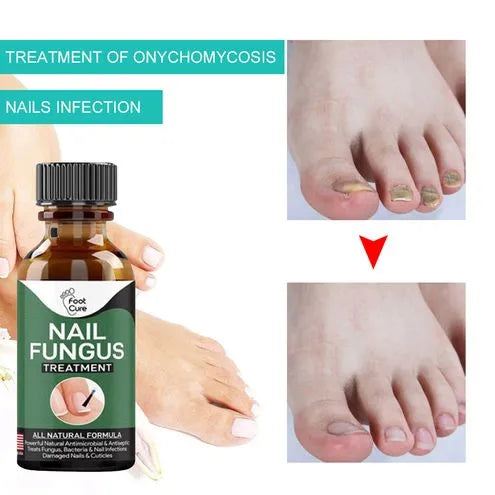 Nail Fungus Serum